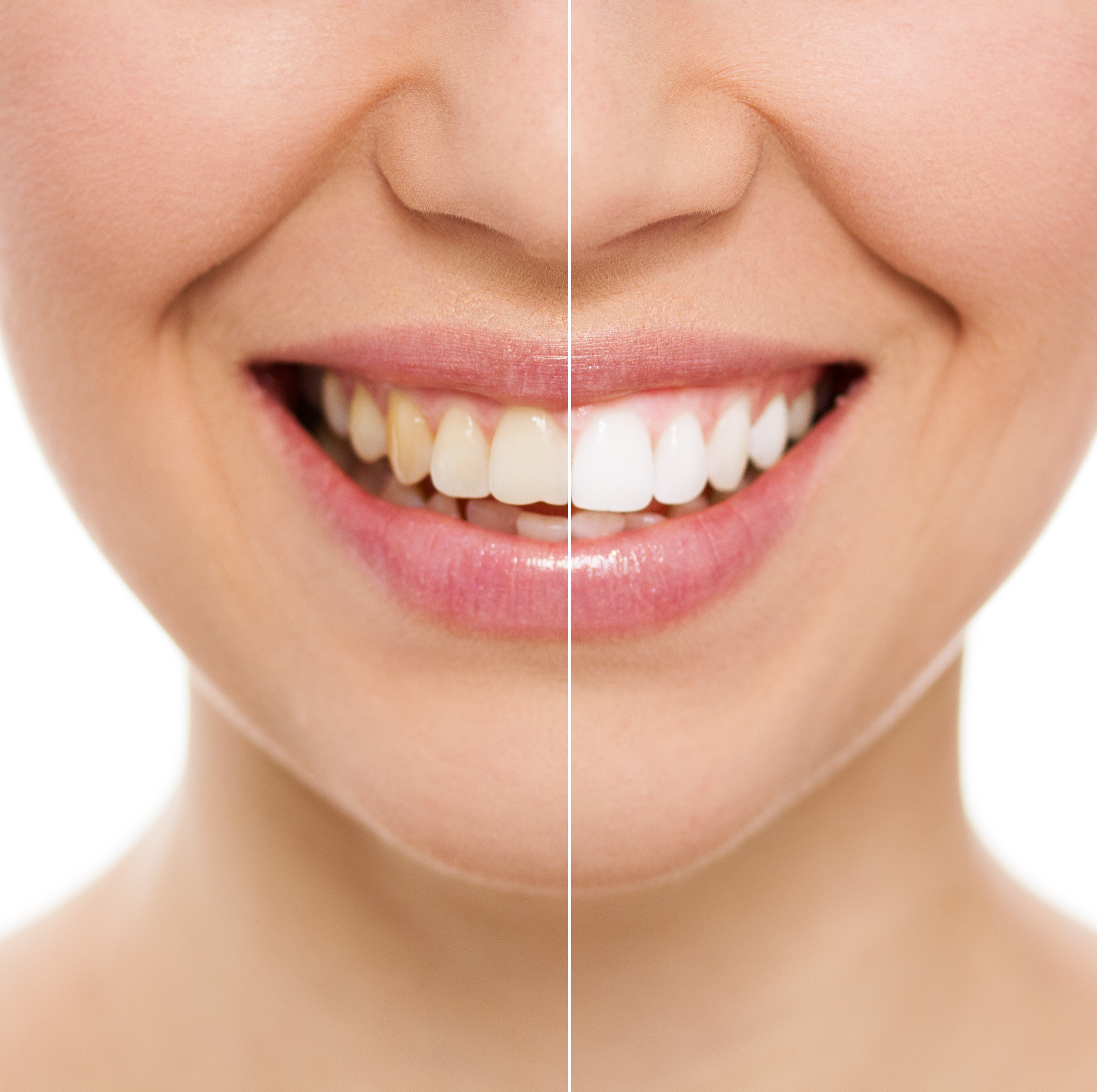 Sonrisa blanca tras un blanqueamiento dental